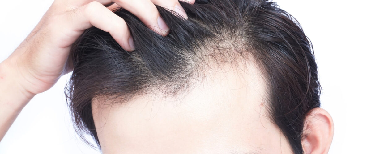 What To Do When You Notice Hair Loss